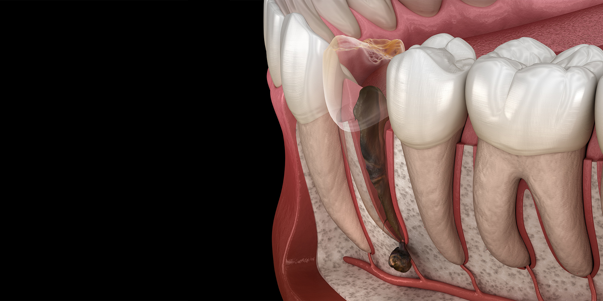Apicoectomy | Rocky Hill & Bristol, CT | Oral Surgeon